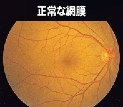 正常な網膜