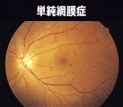 単純網膜症
