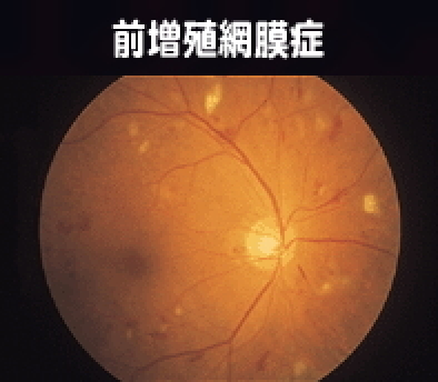 前増殖網膜症