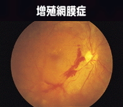 増殖網膜症