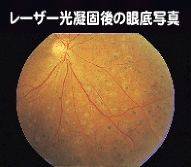 レーザー光凝固後
